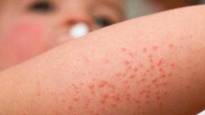La dermatitis atópica es un desafío para los profesionales de salud y  pacientes