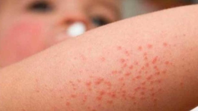 El 14 de septiembre se conmemora el Da Mundial de la Dermatitis Atpica.