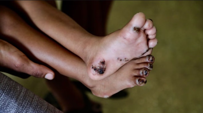 La tungiasis afecta principalmente a nios y las personas de comunidades vulnerables.
