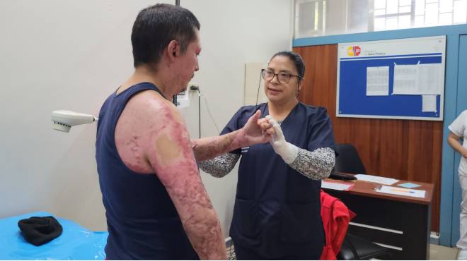 Servicio para quemaduras en el Hospital Vicente Corral Moscoso