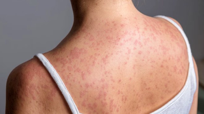 Los brotes de sarampi�n se propagan en poblaciones no vacunadas, principalmente.